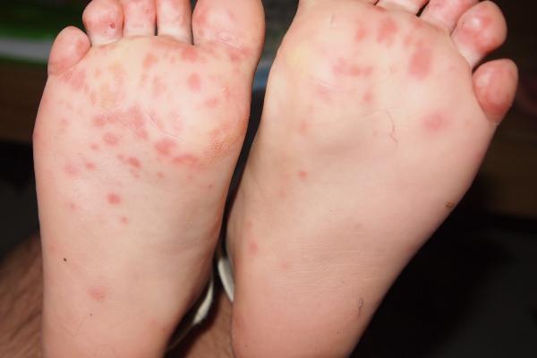 close up of hand, foot, and mouth disease reaction on the bottom of someone's feet.