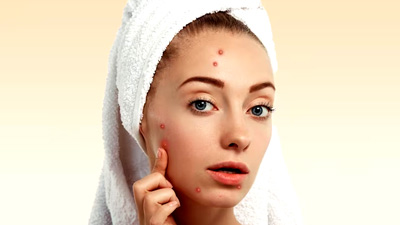 Women struggling with acne on her forehead and cheek bone region