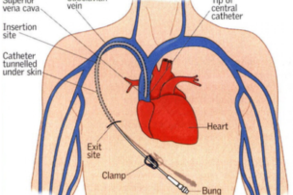 Diagram of the human torso showing different iv and catheter ports