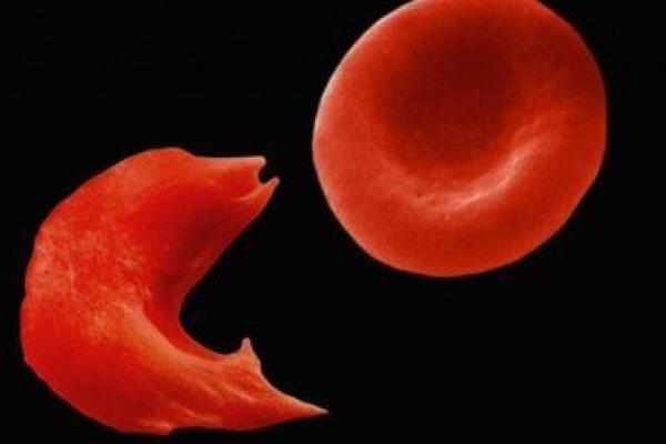 Sick cell disease in red blood cells