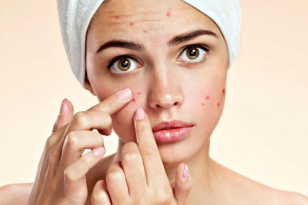 Girl with acne who is touching her face